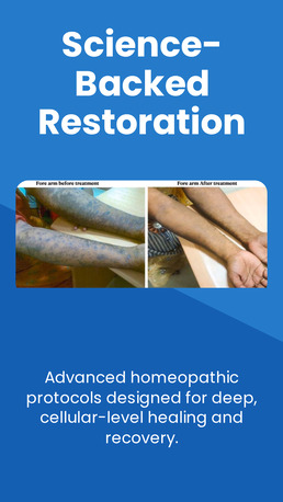 Faridabad, Health, Homeopathy Treatment For Lichen Plannus