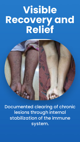 Faridabad, Health, Homeopathy Treatment For Lichen Plannus