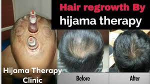 Riyadh, Sporting Goods, SAR 200,  Hijama - The Best Treatment For Cleansing Your Body & Soul.