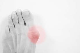Singapore, Health, 5 Awesome Tips On Surviving Your First Bunion Surgery Recovery