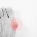5 Awesome Tips On Surviving Your First Bunion Surgery Recovery