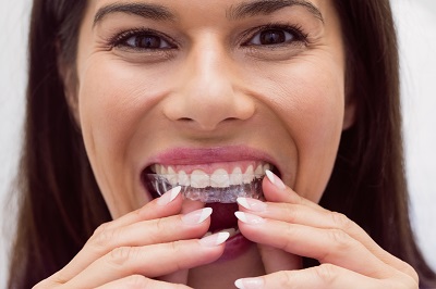 Dublin, Health, Invisible Braces Dublin | Straight Teeth Without Braces