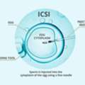 ICSI Treatment In Delhi - Dr Rhythm Gupta