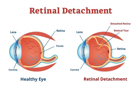 New York, Health, Advanced Care For Retinal Detachment & Tears Treatment