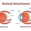 Advanced Care For Retinal Detachment & Tears Treatment