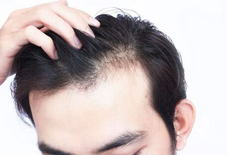 Punjab, Health, Professional Hair Transplantation In Punjab