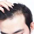 Professional Hair Transplantation In Punjab