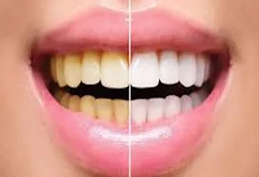 Kolkata, Dental, Teeth Whitening & Scaling Treatment New Town | Creating Smiles Clinic