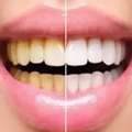 Teeth Whitening & Scaling Treatment New Town | Creating Smiles Clinic