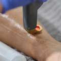 Laser Hair Removal & Skin Care In Windham NH
