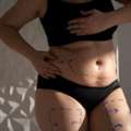Tummy Tuck In South Africa For A Flatter And Toned Abdomen