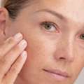 Effective Melasma Treatment In Vasant Kunj For Clearer, Even-Toned Skin