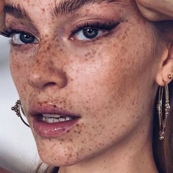 Toronto, Health, Advanced Skin Pigmentation Treatment Toronto