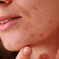Gentle Foam Cleanse For Daily Breakout Care