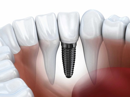 San Diego, Health, Tooth Implant Cost