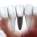 Tooth Implant Cost
