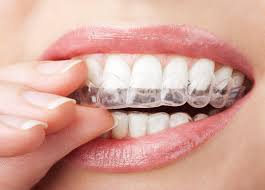 Los Angeles, Dental, Invisalign Near You For Comfortable And Modern Smile Correction