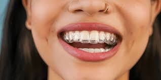 Los Angeles, Dental, Invisalign Near You For Comfortable And Modern Smile Correction