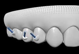 Los Angeles, Dental, Invisalign Near You For Comfortable And Modern Smile Correction
