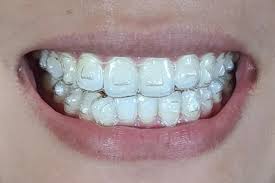Los Angeles, Dental, Invisalign Near You For Comfortable And Modern Smile Correction