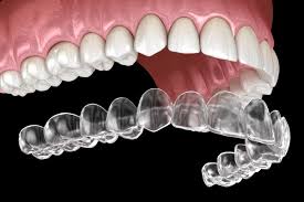 Los Angeles, Dental, Invisalign Near You For Comfortable And Modern Smile Correction