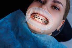 London, Health, Whitton Dental Excellence &mdash; Implants, Whitening & More