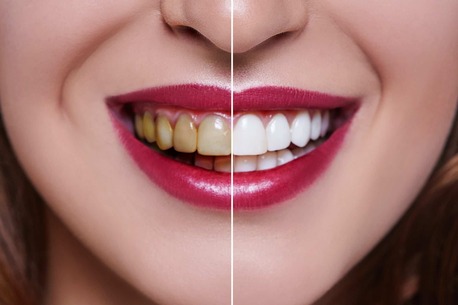 Jaipur, Dental, Best Clinic For Teeth Whitening Near Me In Jaipur