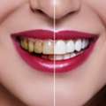 Best Clinic For Teeth Whitening Near Me In Jaipur