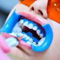 Teeth Whitening Fort Worth