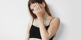 Faridabad, Health, How Long Does It Take For Vitiligo To Spread All Over The Body? | Vitiligo Treatment