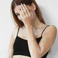 How Long Does It Take For Vitiligo To Spread All Over The Body? | Vitiligo Treatment