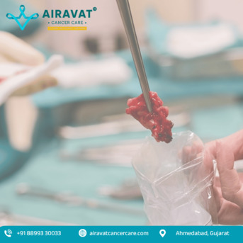 Ahmedabad, Health, Best Cancer Surgeon In Ahmedabad | Expert Cancer Treatment At Airavat Cancer Care