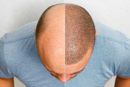 New Delhi, Health, Hair Transplant Surgery In Delhi &ndash; Natural & Permanent Results