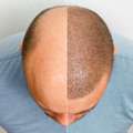 Hair Transplant Surgery In Delhi &ndash; Natural & Permanent Results