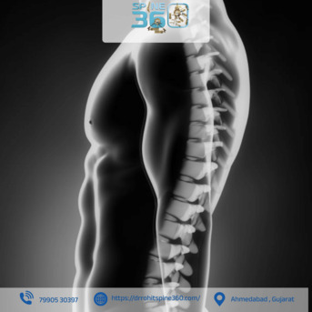 Ahmedabad, Health, Effective Spinal Fusion Surgery For Long-Term Relief In Ahmedabad By Dr. Rohit Thaker