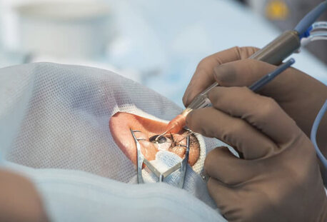 Mumbai, Health, Can I Live With Cataracts Without Surgery?