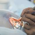 Can I Live With Cataracts Without Surgery?
