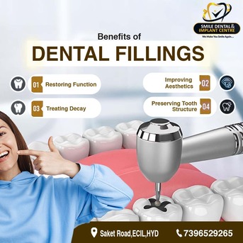 Hyderabad, Dental, The Ultimate Guide To Dental Fillings & Laser Care At Smile Dental & Implant Centre