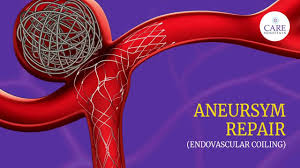 Punjab, Health, Advanced Aneurysm Endovascular Coiling Treatment At IR Facilities
