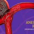 Advanced Aneurysm Endovascular Coiling Treatment At IR Facilities