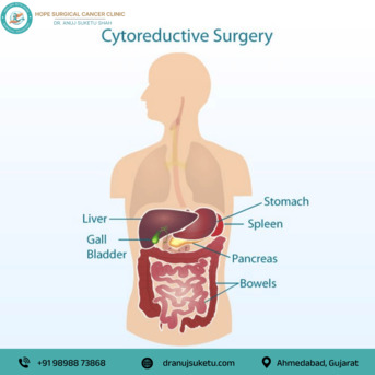 Ahmedabad, Health, Expert Cytoreductive Surgery In Ahmedabad For Advanced Cancer Care