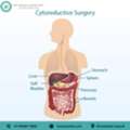 Expert Cytoreductive Surgery In Ahmedabad For Advanced Cancer Care