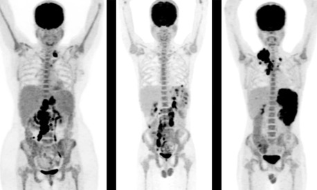Mumbai, Medical, Accurate PET Scan In Mumbai For Cancer Detection &ndash; Picture This