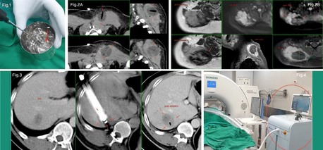 Mumbai, Medical, Advanced Cryoablation Therapy For Tumours In Mumbai &ndash; Picture This