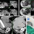 Advanced Cryoablation Therapy For Tumours In Mumbai &ndash; Picture This