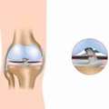 Understanding The Costs Of ACL Surgery In Singapore: A Comprehensive Guide
