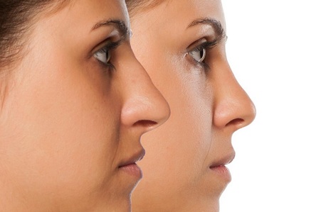 Mumbai, Health, Nose Reshaping In Andheri &ndash; Expert Rhinoplasty Surgeon