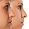 Nose Reshaping In Andheri &ndash; Expert Rhinoplasty Surgeon