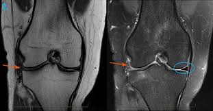London, Health, Fast & Accurate MRI Of Knee Joint For Pain Diagnosis | Marris Medical London