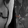 Fast & Accurate MRI Of Knee Joint For Pain Diagnosis | Marris Medical London